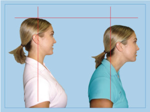 forward-head-posture